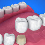 Dental Crown And Bridge: Restoring Your Smile’s Integrity