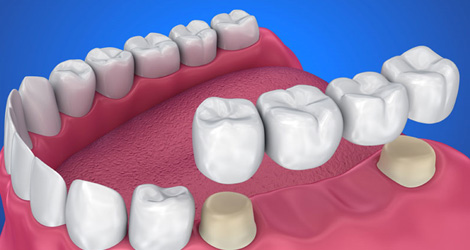 Dental Crown And Bridge: Restoring Your Smile's Integrity